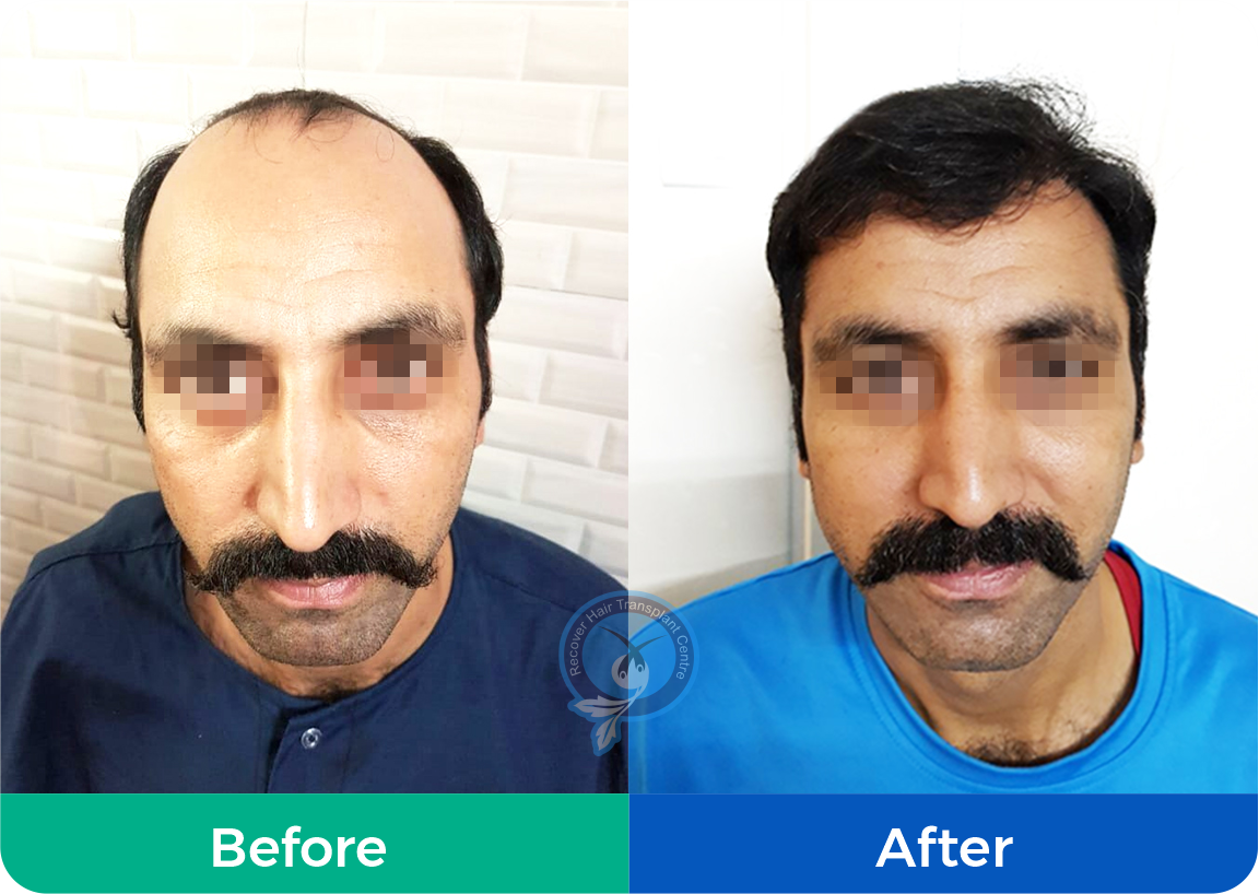 Recover Hair Transplant | Natural Hairline | Painless Procedure
