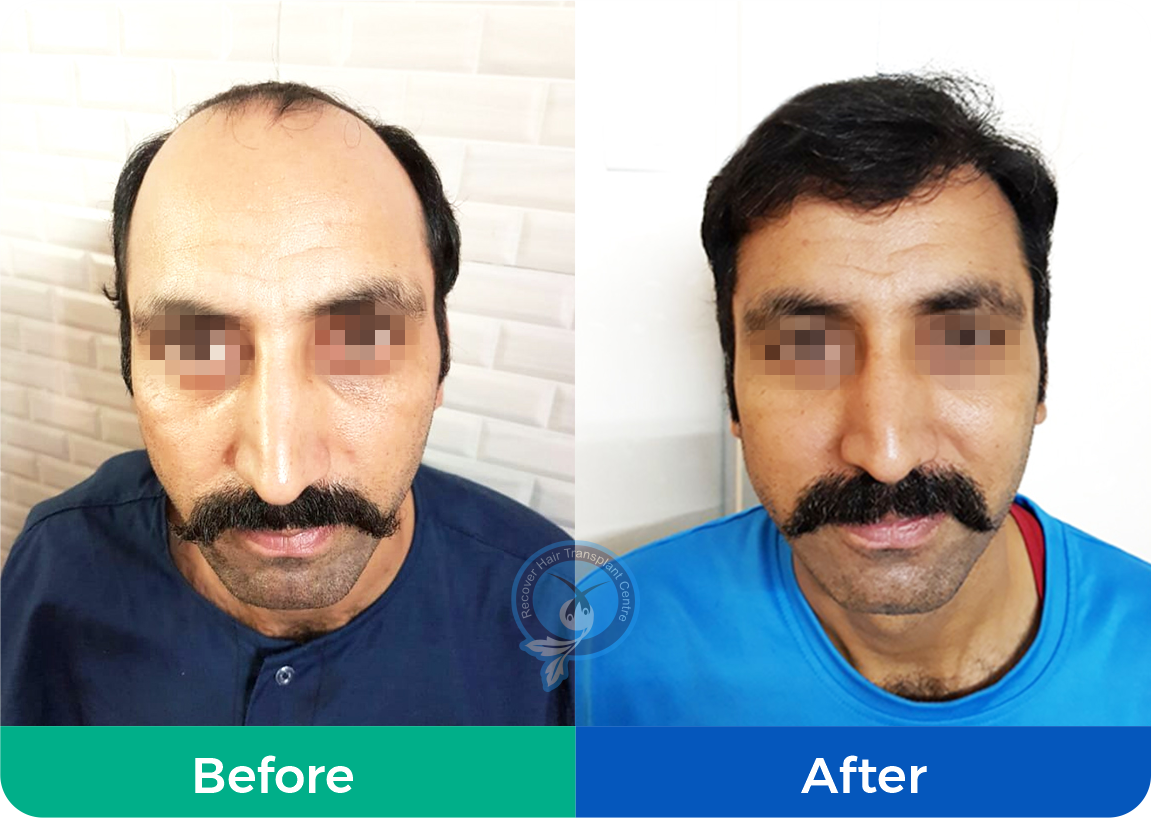 Top Beard Hair Transplant in Chandigarh