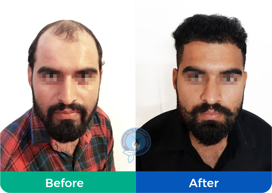 Recover Hair Transplant | Natural Hairline | Painless Procedure