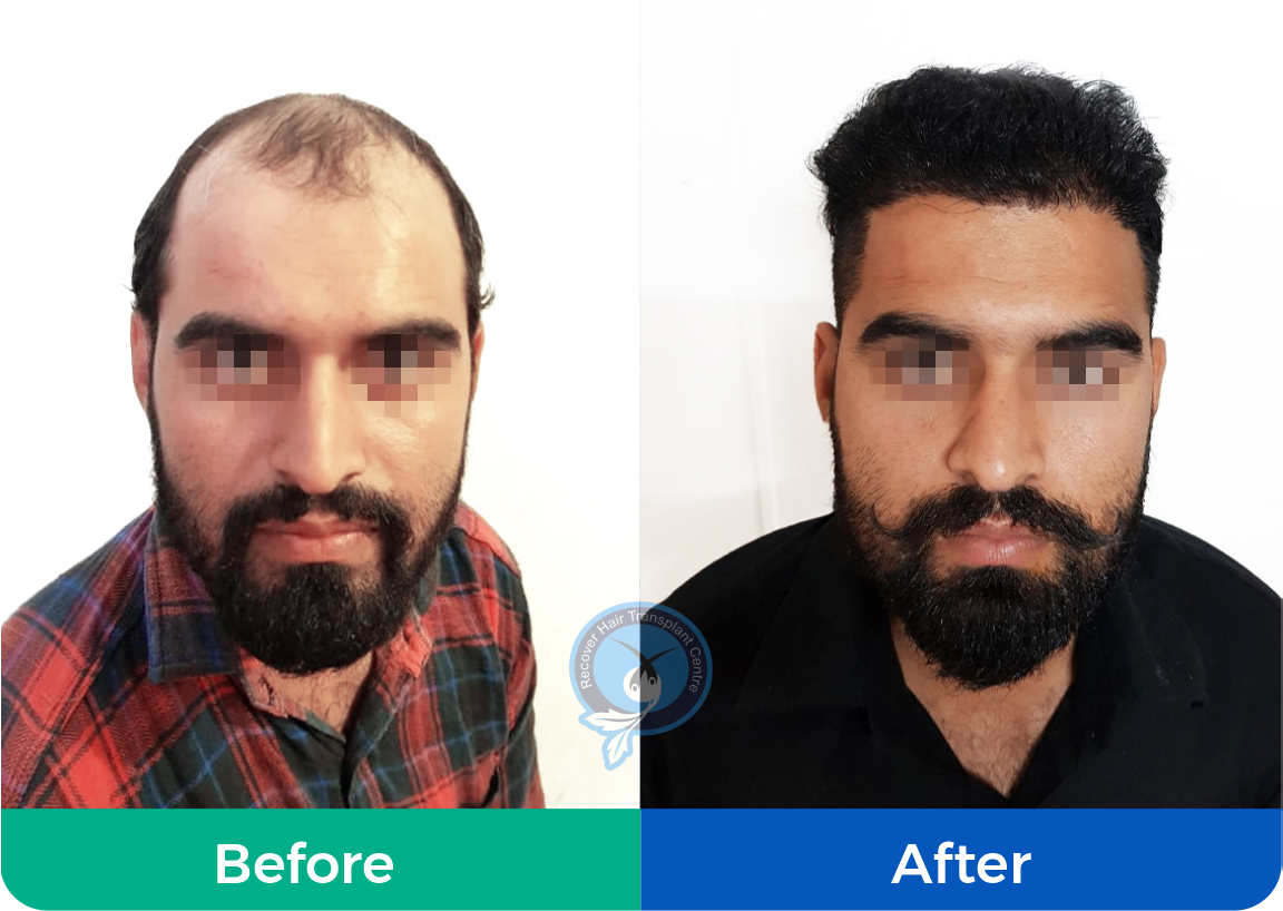 Male Hair Transplantation Center in Gurugram India  Eugenix