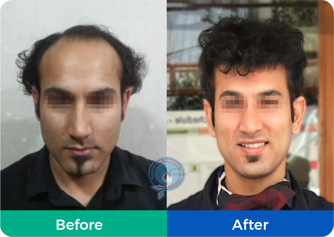 Niraj Kakkar  Doctor  Hair Transplant in India  LinkedIn