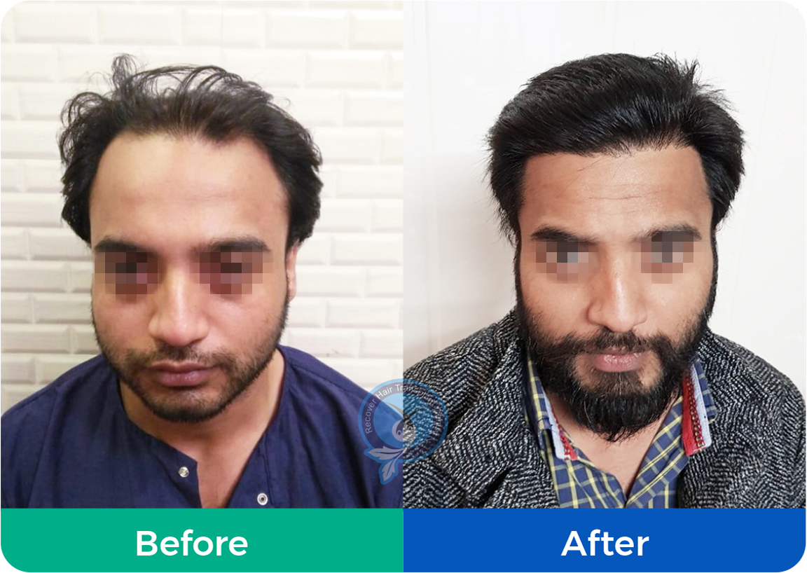 Best Hair Transplant in Delhi Noida Meerut Moradabad