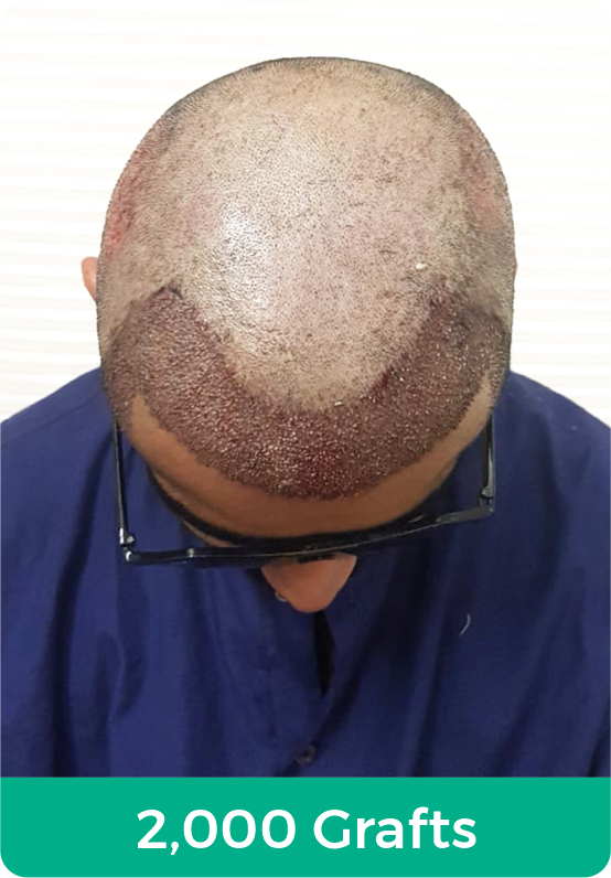 Services | Hair Transplant Cost | Guarantee