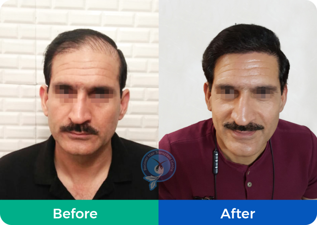 Before & After | Hair Transplant Results | Testimonials