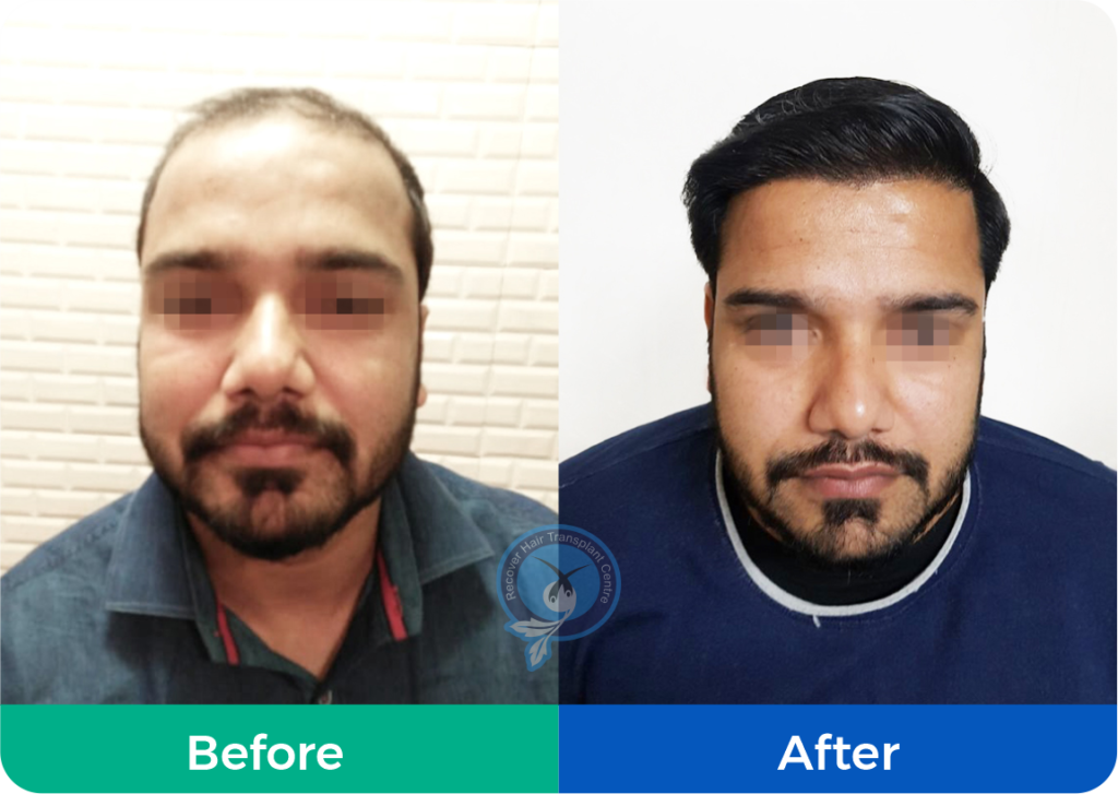 Recover hair transplant recoverhairtransplant  Instagram photos and  videos